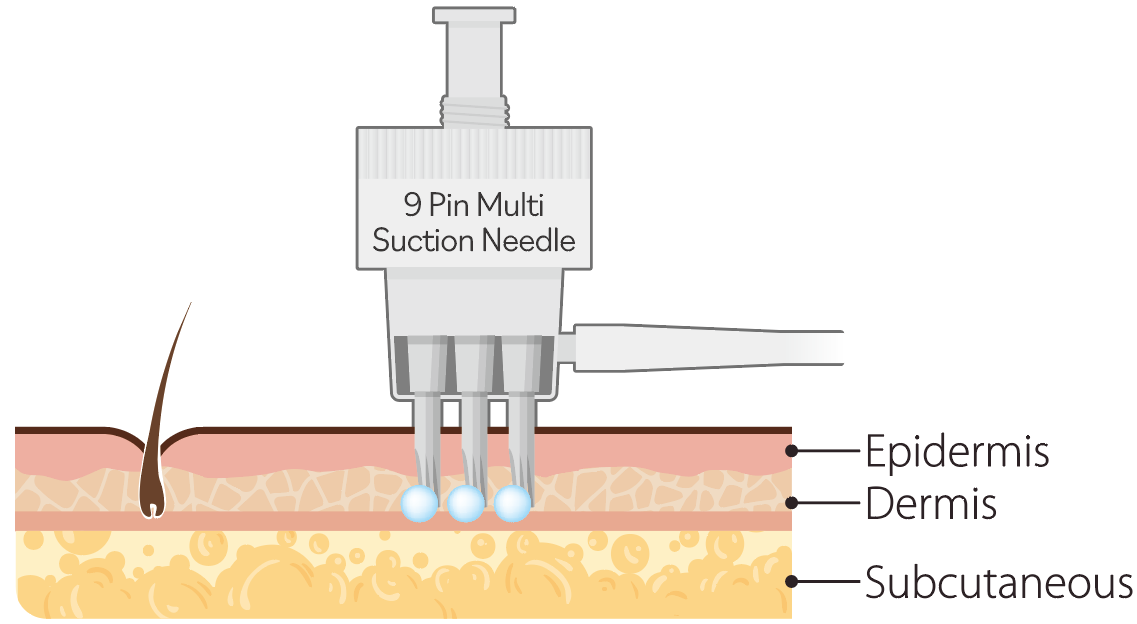 what is a Mesogun?